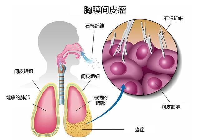 石棉瓦放在房间里有毒吗,家里有石棉瓦会挥发到空气中吗(2)