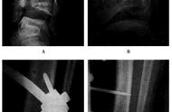 骨科外支架固定图解（骨科内固定取出术操作视频）